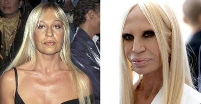 Donatella Versace S Plastic Surgery Caused Face Disaster Before And After Pictures Glamour Path