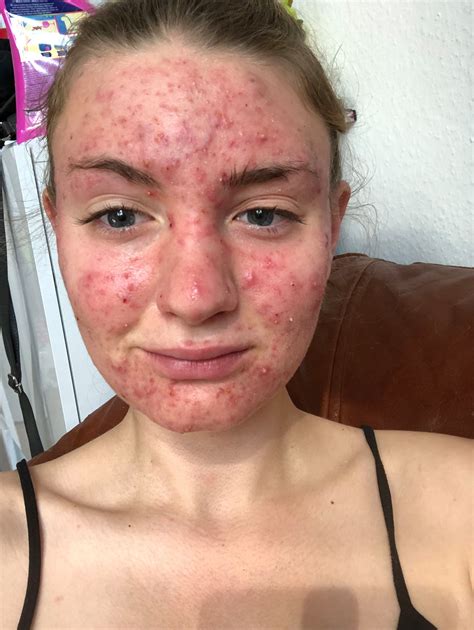 Id Never Had A Spot But Broke Out With Painful Cystic Acne After