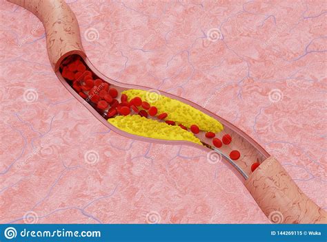 Atherosclerosis In Artery Stock Illustration Illustration Of
