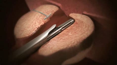 The Urolift System A Minimally Invasive Enlarged Prostate Treatment