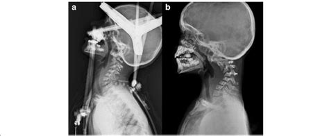 A Lateral Cervical Spine X Ray Showing Correction Of The Deformity With