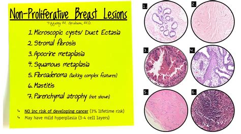 Benign Diseases Of The Breast An Overview