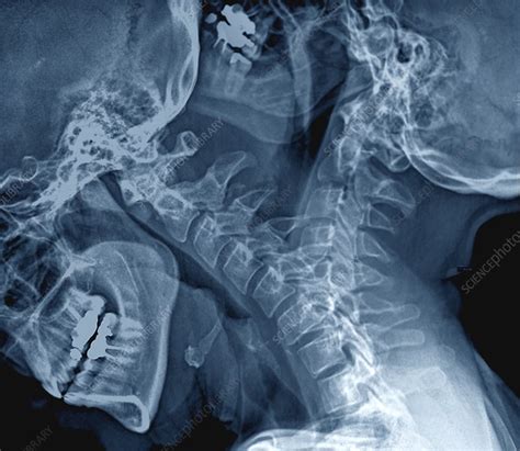 Flexion Of The Cervical Spine X Rays Stock Image C0480638