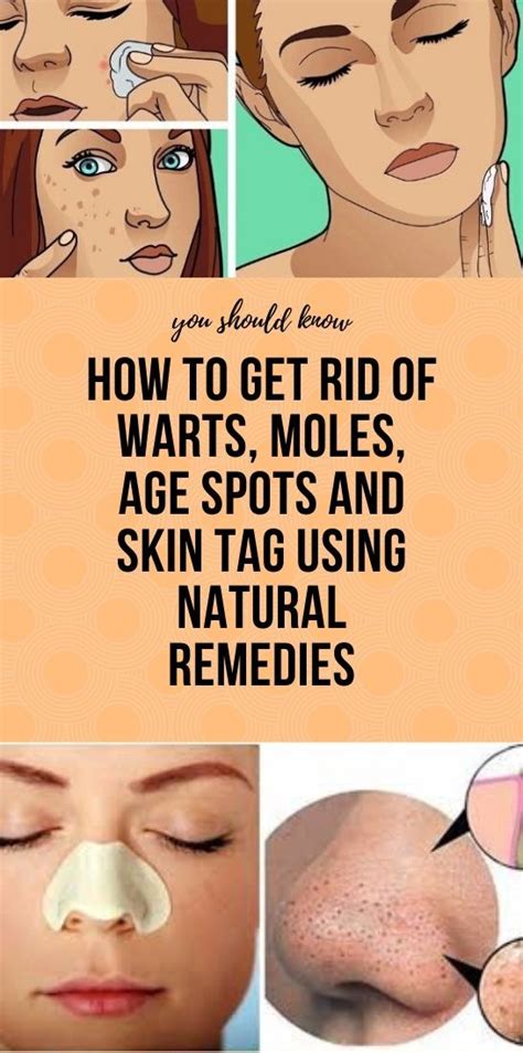 how to get rid of warts moles age spots and skin tag using natural remedies natural health