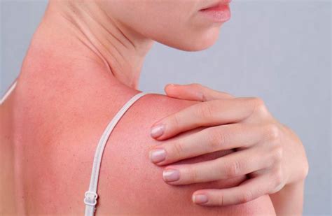 Sun Poisoning Causes Symptoms And Treatments Usa Health Articles
