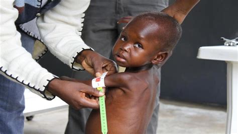 tackling the dual burden of malnutrition in nigeria a multisectoral approach