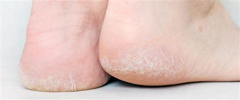 Dry Skin And Cracked Heels Waverley Foot Clinic