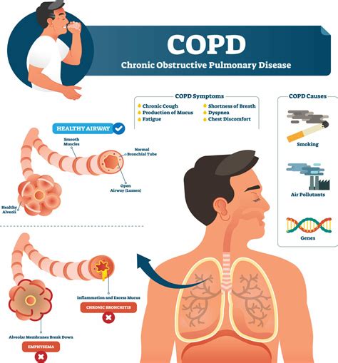 Chronic Obstructive Pulmonary Disease Copd Treatment London Pelajaran
