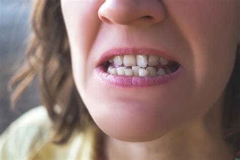Crooked Misaligned And Gapped Teeth Platinum Smile Dentist Mandurah