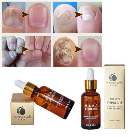 10ml Nail Treatment Cream Onychomycosis Nail Remove Anti Fungal