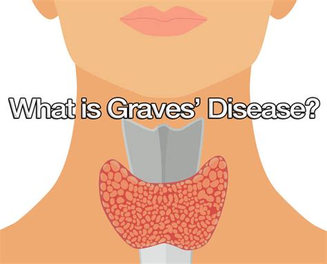 What Is Graves Disease Thyroid Advisor