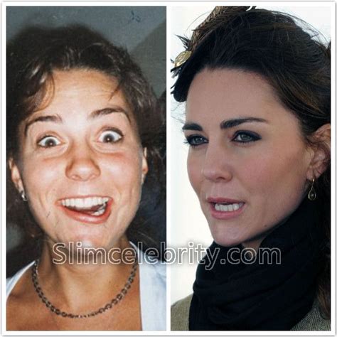 Kate Middleton Plastic Surgery Before And After Photos Nose Job
