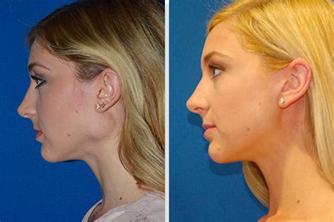 Facial Rejuvenation Advances In Facelift Surgery Cosmetic And