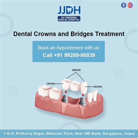 Dental Crown Bridges Treatment Dentagama