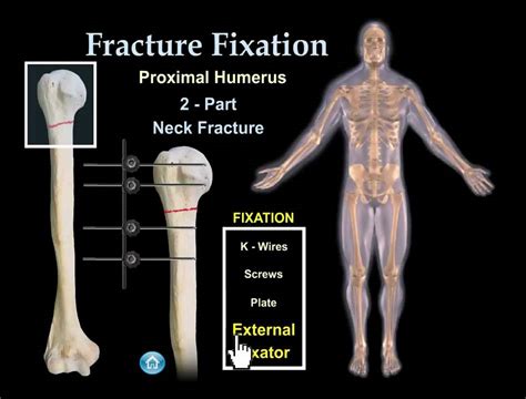 Fracture Fixation Animation Everything You Need To Know Dr Nabil