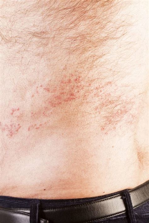 Shingles Symptoms Causes Rash Treatment In Australia Vrogue Co