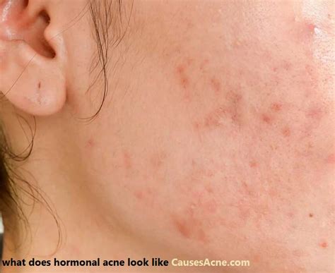 What Does Hormonal Acne Look Like Causes Acne