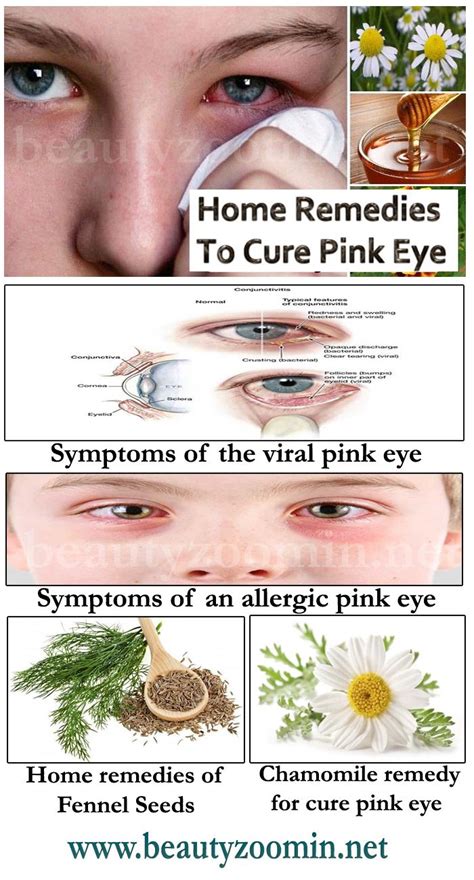 Fast And Easy Home Remedies To Cure Pink Eye And Itching In 2021 Pink