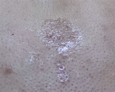 Skin Concern Dry Scaly Skin Patch On Chest I Dont Know What It