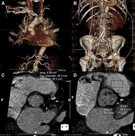 Transcatheter Aortic Valve Implantation In Severe Native Pure Aortic