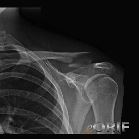 Distal Clavicle Fracture Cases Eorif