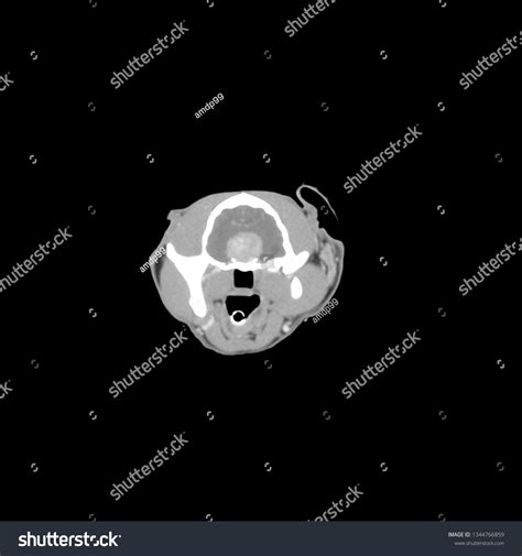 Pituitary Tumor Shown On Ct Scan Stock Illustration