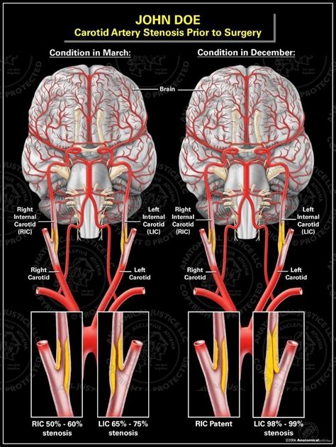 Internal Carotid Artery Stenosis