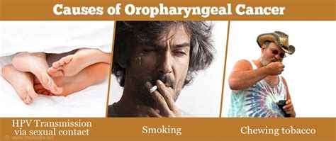 Oropharyngeal Cancer Medical Tech News The Latest Health News