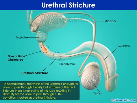 Urethral Stricturetreatmentexerciseprognosiscausessymptoms