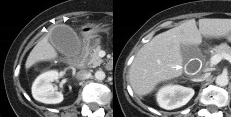 The Radiology Assistant Gallbladder Wall Thickening