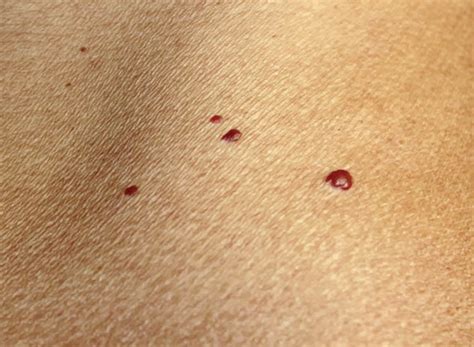 Blood Spots On Skin