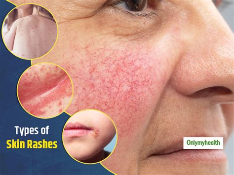 A Dermatologists Guide To 7 Types Of Skin Rashes A Dermatologists