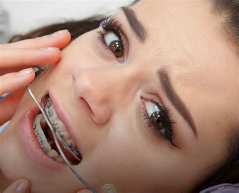 What Is Headgear Braces Used For In Orthodontics Estes Orthodontics