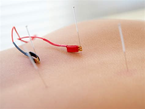 using electronic stimulation with acpuncture