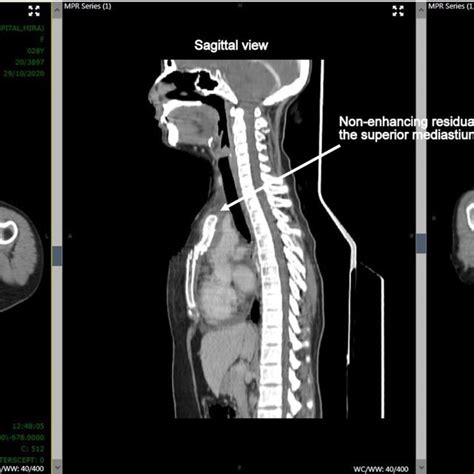 Pre‐rt Cect Scan Of The Neck And Thorax Showing A Heterogeneously