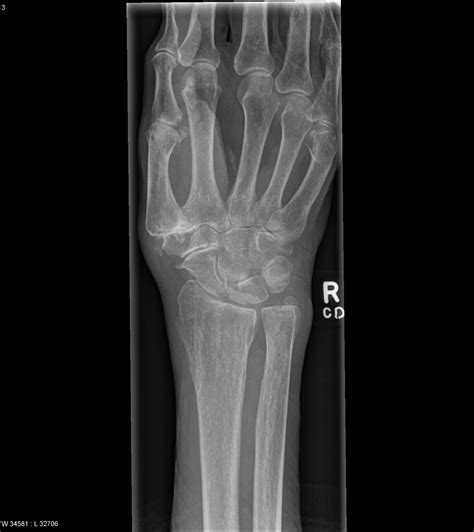 Distal Radial Fracture Triscaphe And First Carpometacarpal Joint Osteoarthritis Image