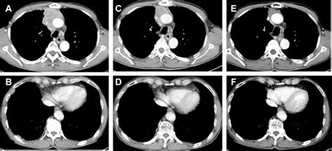 Chest Computed Tomography Before The First Line Treatment A And B