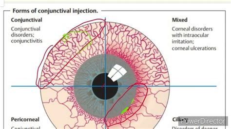Conjunctiva Red Eye Conjunctival And Ciliary Congestion