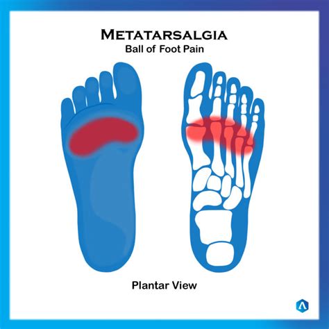 Metatarsalgia Ball Of Foot Pain Dr Abbie Clinics