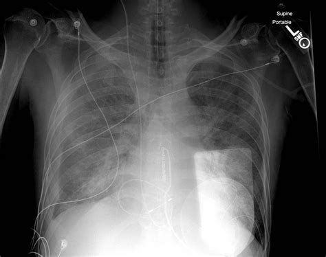 Transvenous Cardiac Pacing Pitfalls Resus Review