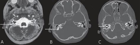 Interpreting Pendred Syndrome As A Foetal Hydrops Clinical And Animal