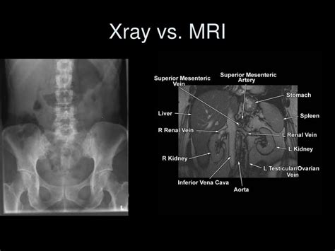 Difference Between Mri And X Ray