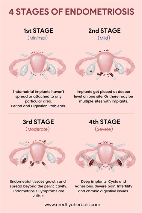 Endometriosis Stages Chart