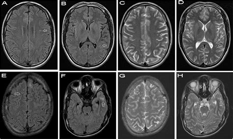Multiple Small Hyperintense Lesions In The Subcortical White Matter On