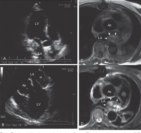 Figure 1 From Left Atrial Intramural Hematoma After Resection Of Myxoma