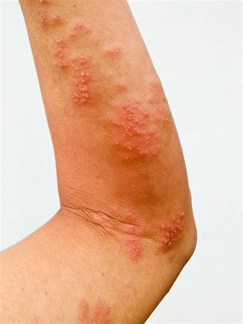 What Is Shingles And Can It Be Treated With Essential Oils Balanced
