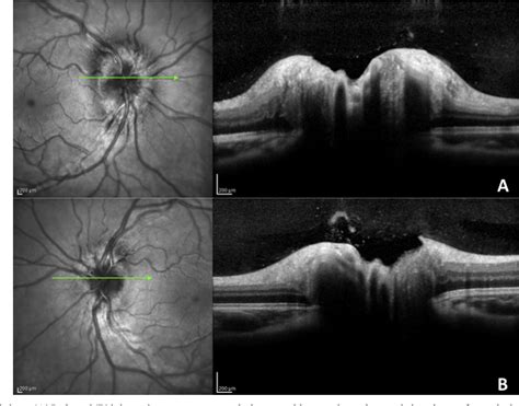 Figure 1 From Differentiating Mild Papilledema And Buried Optic Nerve
