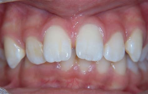 Protruding Front Teeth Ceramic Braces For Children Smile 101