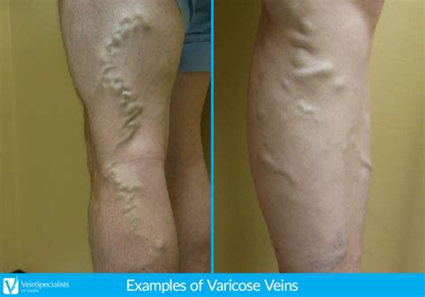 Causes Of Varicose Veins Tampa Fl Vein Care Specialists