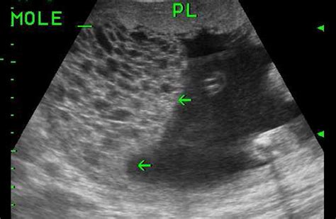 Ultrasound Scan At Weeks Of Gestation Showing A Live Fetus And One